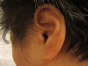 Conmemoran Día Internacional de la Audición y del Cuidado del Oído en Querétaro