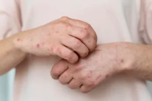 SESEQ mantiene vigilancia con relación a la viruela símica en el primer y segundo nivel de atención 3 SESEQ mantiene vigilancia con relación a la viruela símica en el primer y segundo nivel de atención