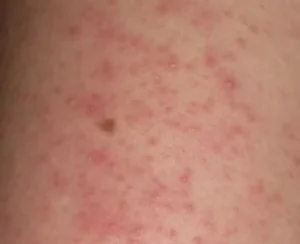 Valoración médica, relevante para cualquier tipo de dermatitis