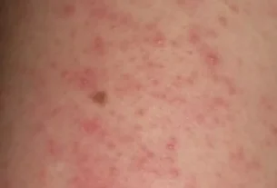 Valoracion medica relevante para cualquier tipo de dermatitis 2