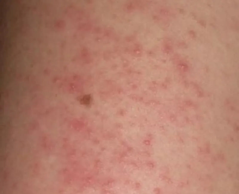 Valoracion medica relevante para cualquier tipo de dermatitis 2